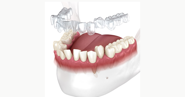 can invisalign pull teeth down
